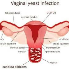 درمان عفونت واژن زنان