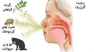 آلرژی بینی یا حساسیت فصلی (Allergic Rhinitis )دکترجدید